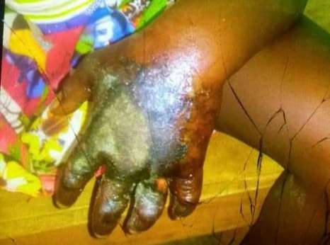 Pai “queima” filha de oito anos por alegado furto de 500 Francos CFA